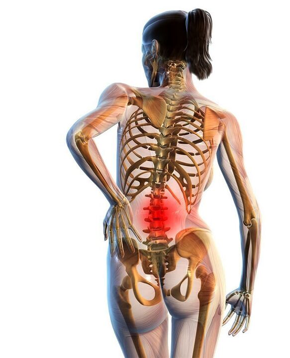 Leggyakrabban az ágyéki gerinc osteochondrosisa fordul elő