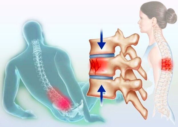 Még egy közönséges sérülés is kiválthatja az osteochondrosis kialakulását