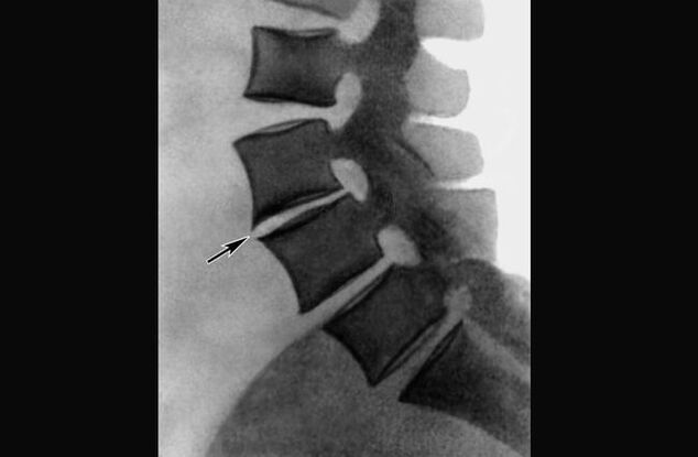 A mellkasi gerinc osteochondrosisának megnyilvánulásai röntgenfelvételen